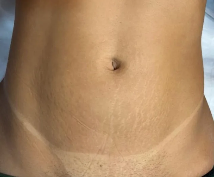 Abdômen antes e depois do tratamento de estrias com MicroPercut — depois